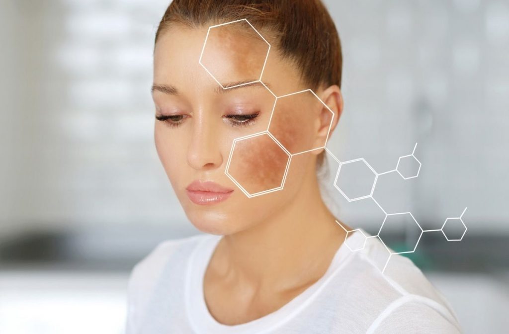 Melasma
